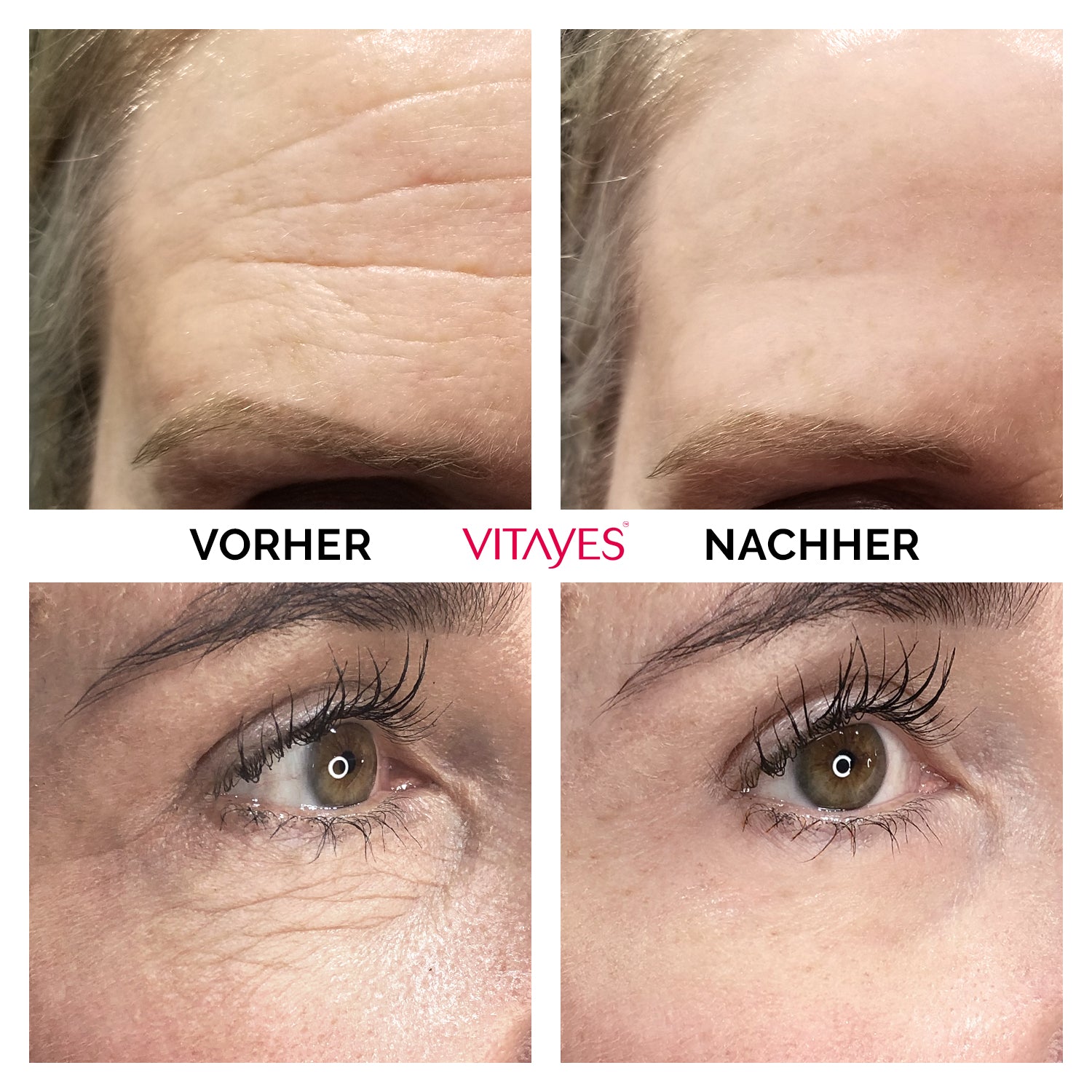 Instant Ageback Lifting-Creme gegen Tränensäcke und Falten, von Vitayes, klinisch bestätigt, für sichtbar straffere Haut.
