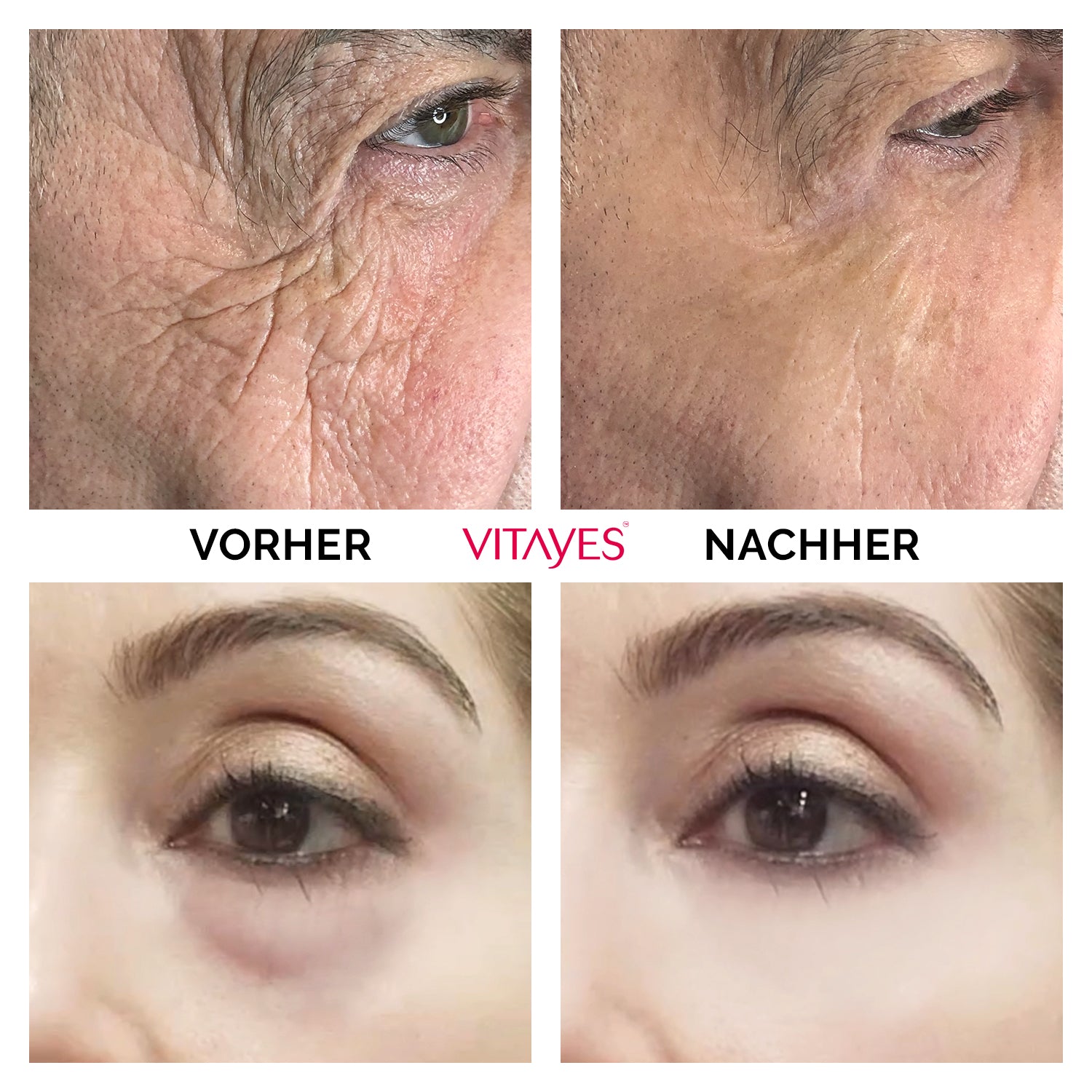 Instant Ageback Lifting-Creme von Vitayes gegen Tränensäcke und Falten auf der Haut, klinisch bestätigt, in einer weißen Tubenverpackung